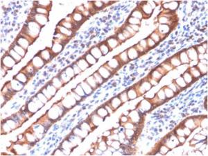 Immunohistochemical analysis of formalin-fixed, paraffin-embedded human small intestinal carcinoma using Anti-Villin Antibody [rVIL1/1325]