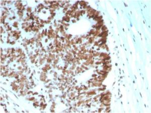 Immunohistochemical analysis of formalin-fixed, paraffin-embedded human colon carcinoma using Anti-MSH6 Antibody [MSH6/2927]